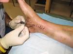 Removing Staples and Stiches from Tami's 'Franken Foot' 15 Days after Surgery in Denver - December 5, 2005