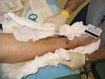 Removing Another one of Tami's Casts at St. Jospeh Hospital, Denver - December 5, 2005
