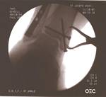 X-ray of Tami's Broken Leg After Surgery in Denver - November, 2005